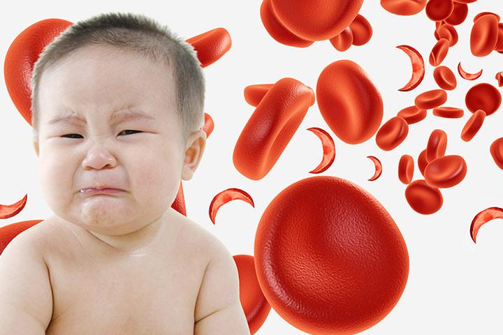 6-serious-symptoms-of-sickle-cell-anemia-in-babies