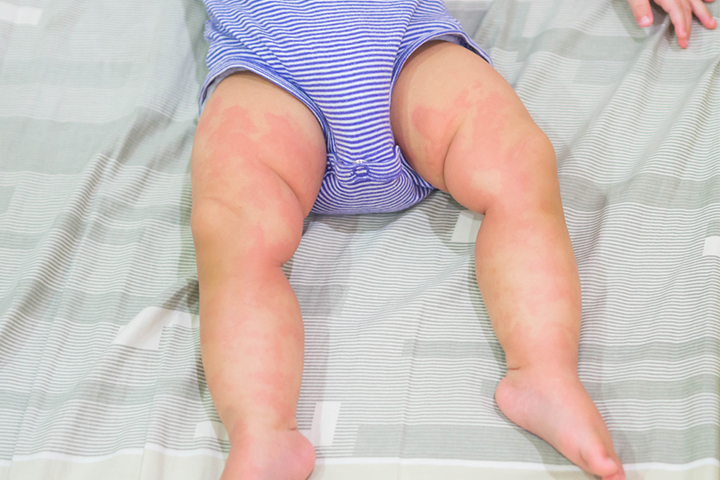 Urticaria, Pea allergy in babies