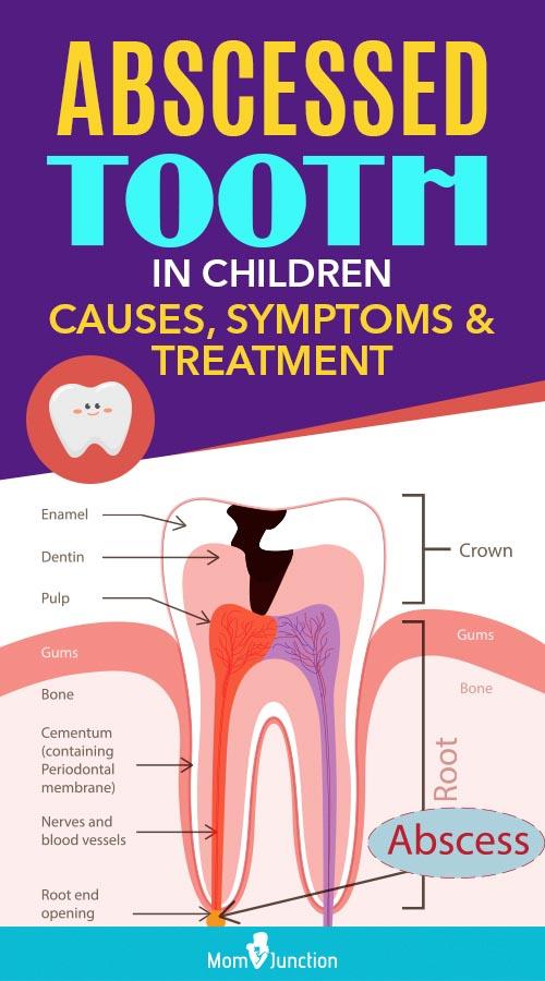 Abscessed Tooth In Child Causes, Symptoms And Treatment