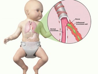 Bronchiolitis In Babies: Causes, symptoms And Treatment
