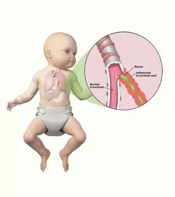 Bronchiolitis-In-Babies
