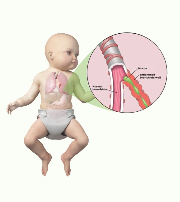 Bronchiolitis In Babies: Symptoms, Diagnosis And Treatment