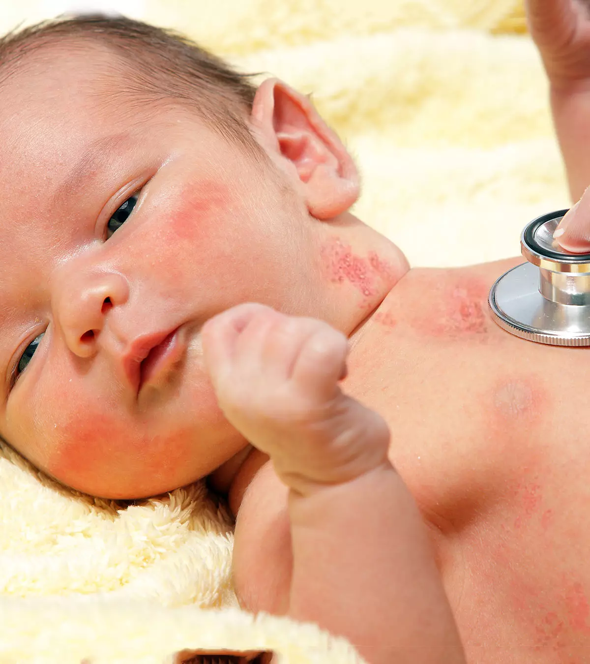 A baby having shingles on the skin