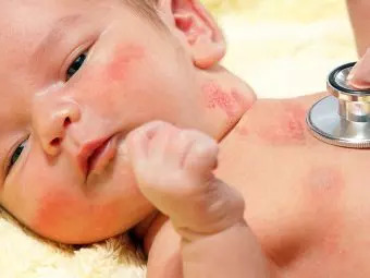 Shingles In Babies: Symptoms, Causes, Diagnosis & Treatment