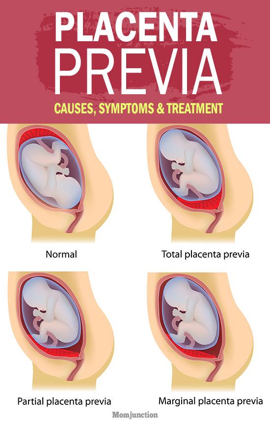 Placenta Previa: Types, Causes, Symptoms And Treatment