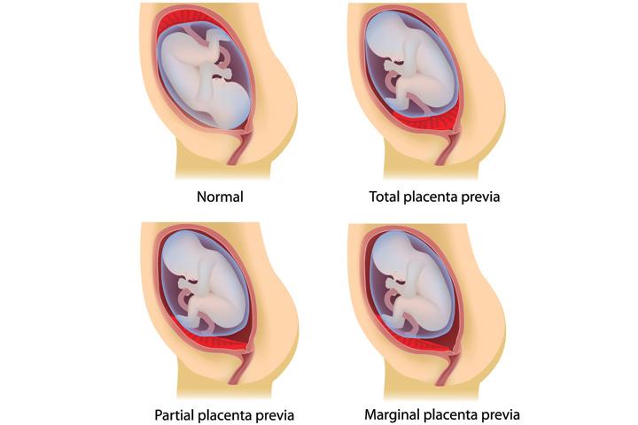 Types of Placenta Previa