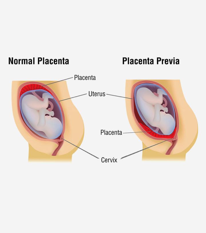 Placenta Previa Types, Causes, Symptoms And Treatment
