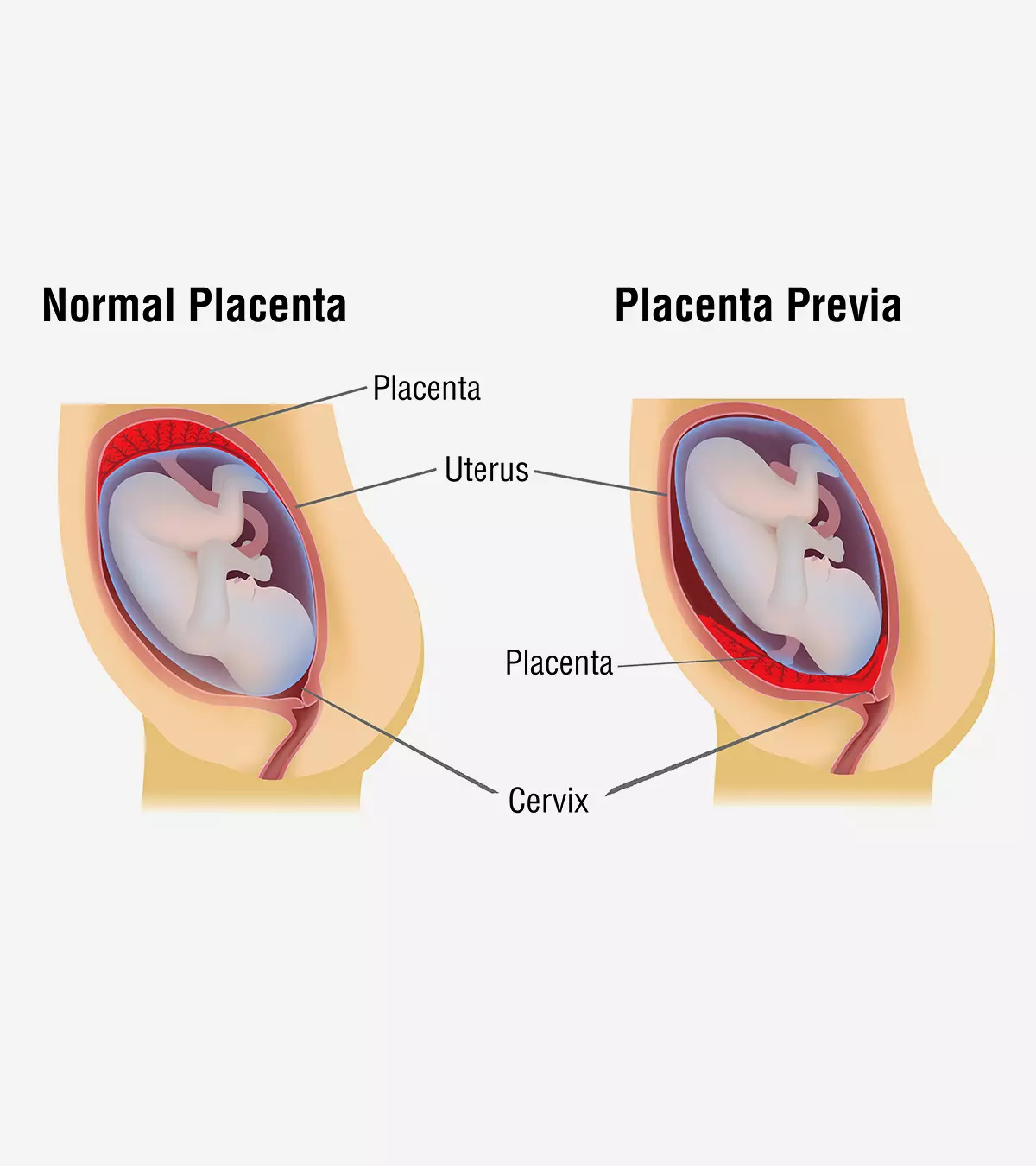 Placenta Previa: What It Is, Types, Causes, And Treatment