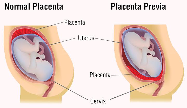 placenta-previa-types-causes-symptoms-and-treatment