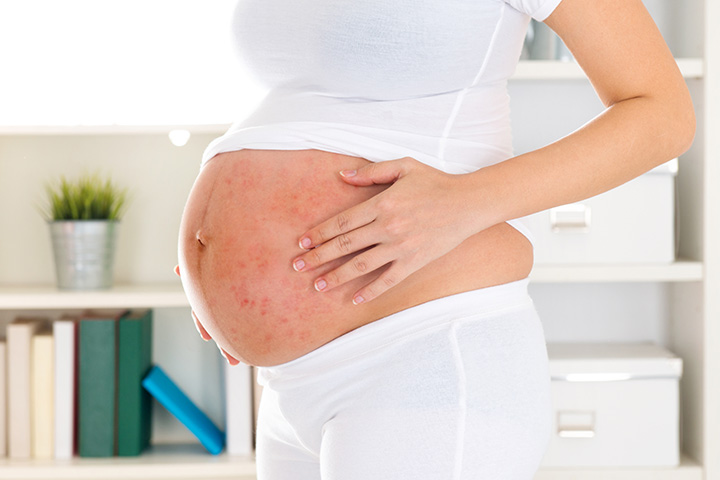 6 Serious Symptoms Of Psoriasis During Pregnancy