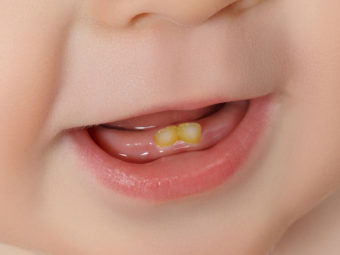 7 Causes Of Tooth Discoloration In Babies & Ways To Treat It