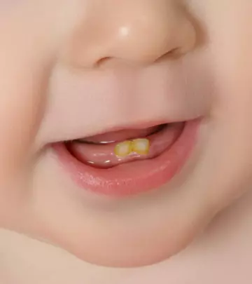 7 Causes Of Tooth Discoloration In Babies & Ways To Treat It