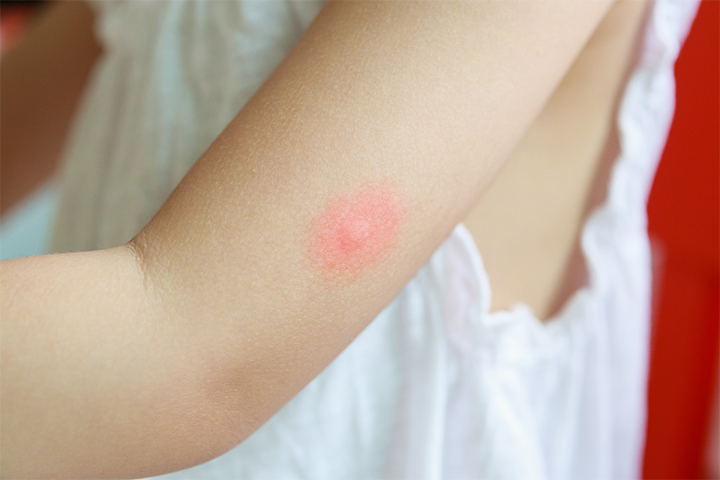 Heat Rashes In Children: How To Treat And Prevent Them