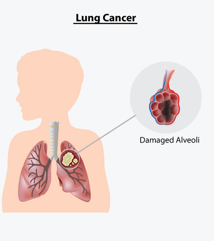 8 Signs And Symptoms Of Lung Cancer In Children & Treatment