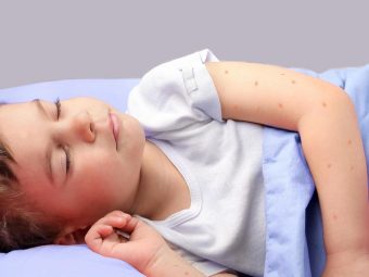 Bed Bug Bites In Kids - Causes And Remedies