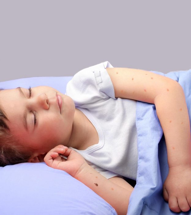臭虫咬的孩子:照片、原因、治疗And Prevention