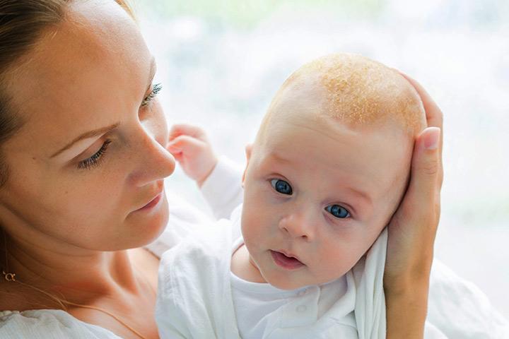 cradle cap cures infant