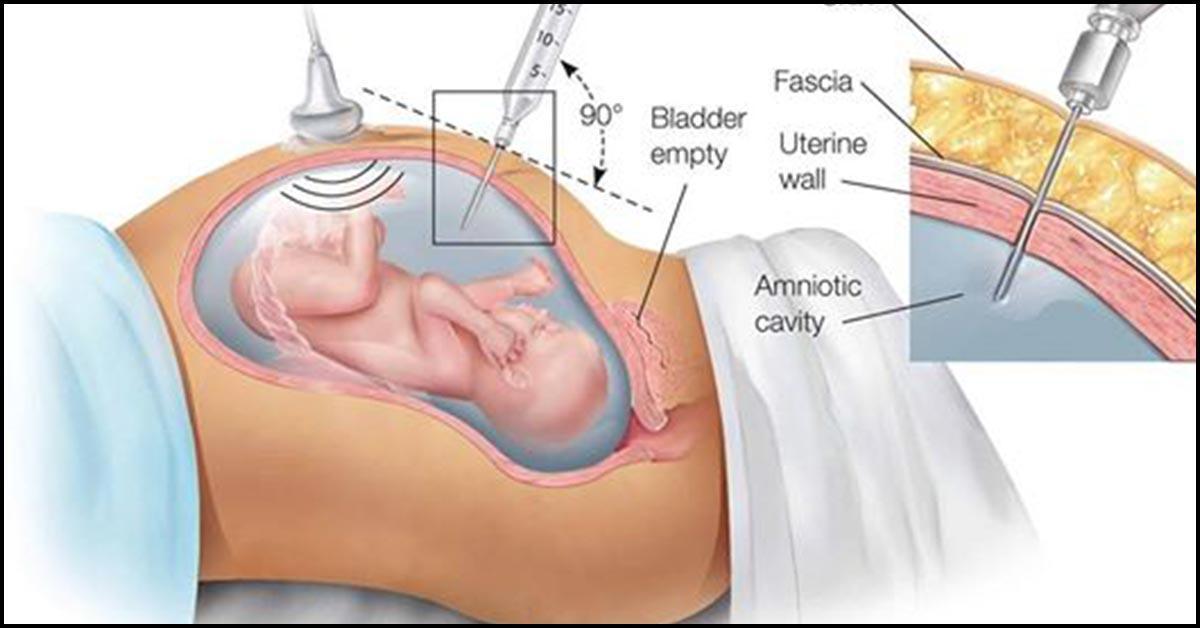 low amniotic fluid at 37 weeks symptoms