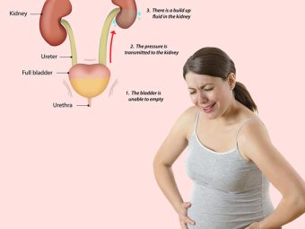 Hydronephrosis In Pregnancy: What It Is, Causes & Treatment
