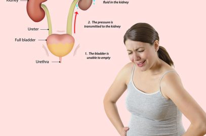 Hydronephrosis During Pregnancy - Causes, Symptoms & Treatments