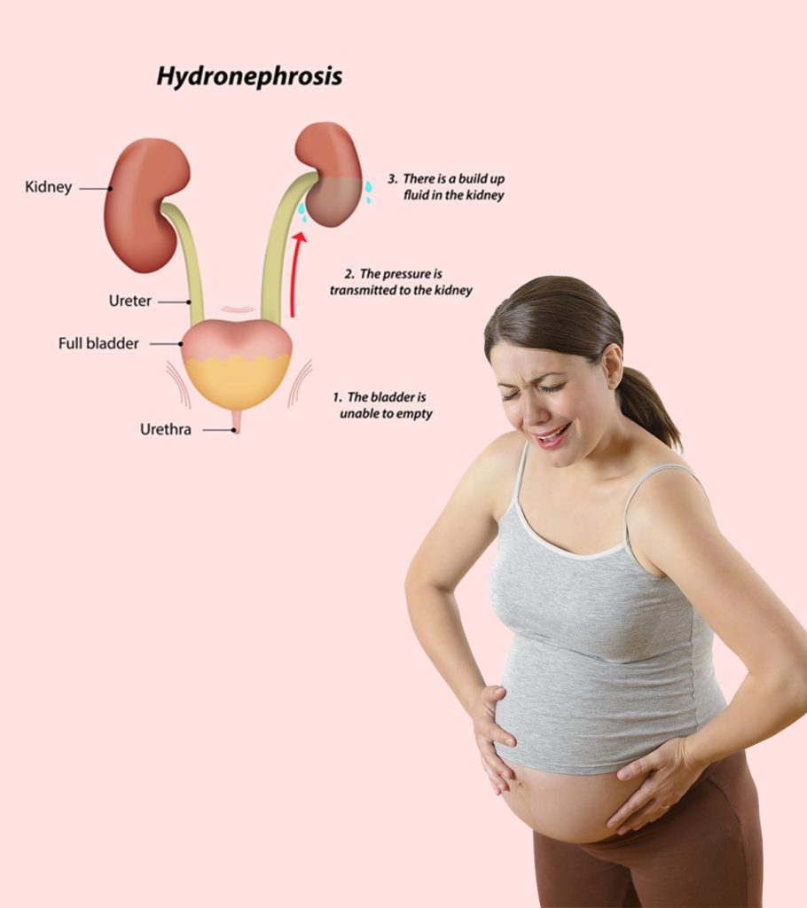Гидронефроз почки у беременной
