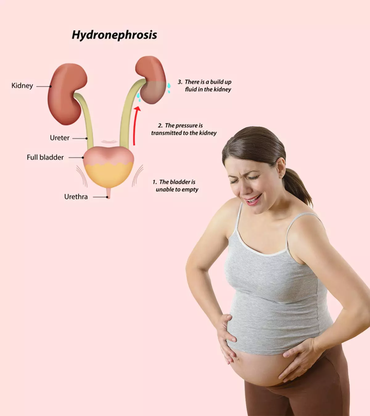 Hydronephrosis During Pregnancy - Causes, Symptoms & Treatments