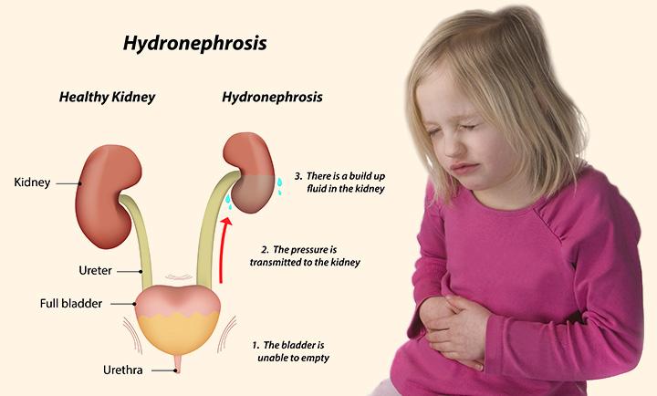 hydronephrosis-in-children-causes-symptoms-and-treatment