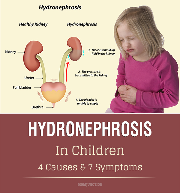 Hydronephrosis In Children Causes Symptoms And Treatment