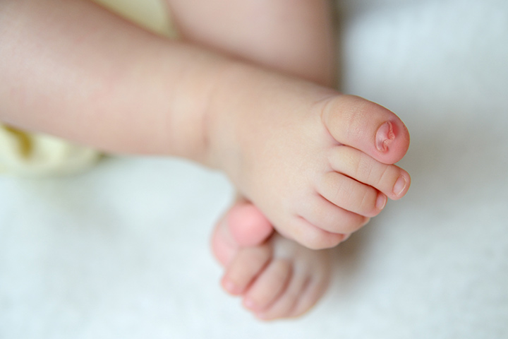 Ingrown Toenail In Babies