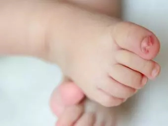 How To Treat And Prevent Ingrown Toenail In Babies?
