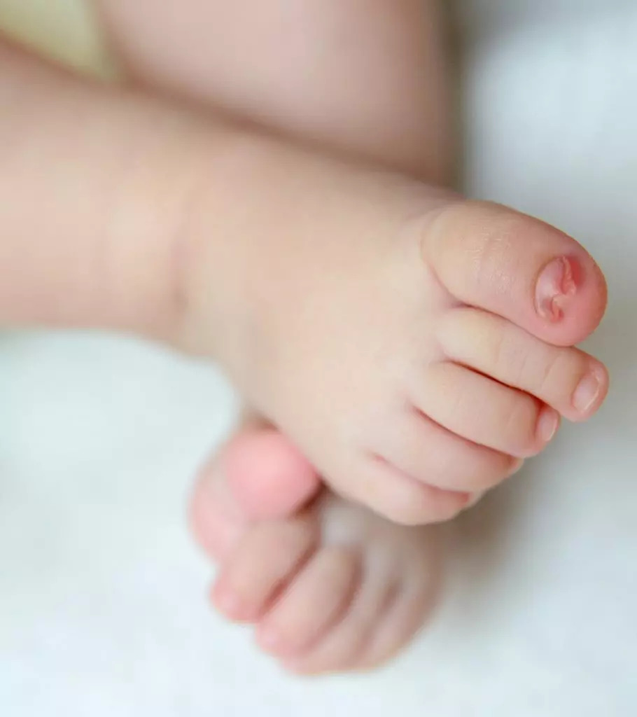 How To Treat And Prevent Ingrown Toenail In Babies 