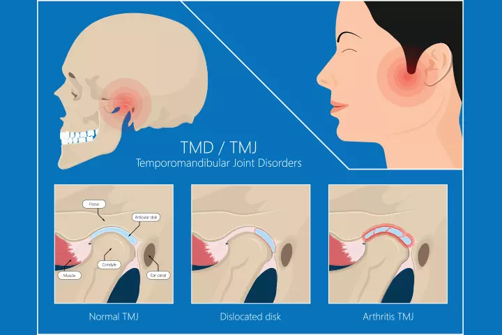 All about jaw pain in pregnancy