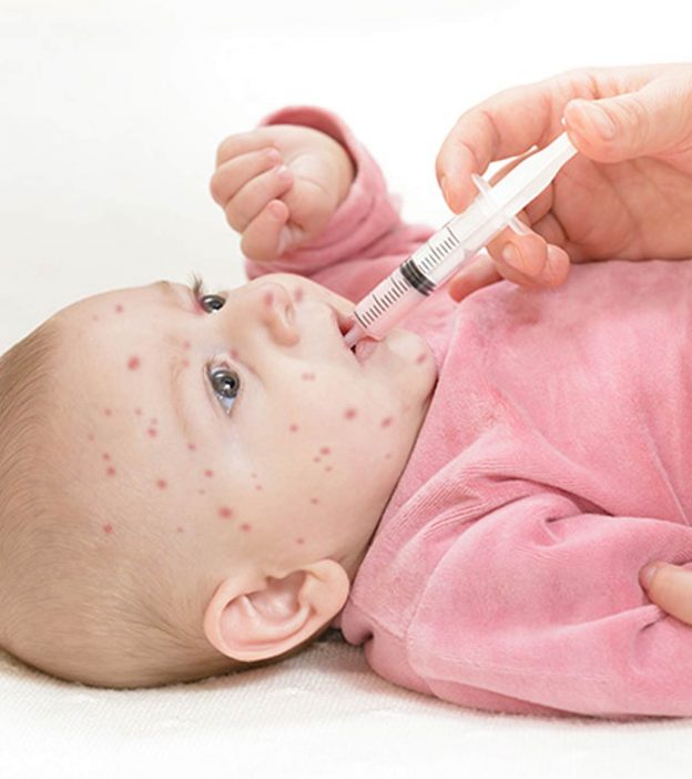 Measles In Babies: Symptoms, Causes And Treatment