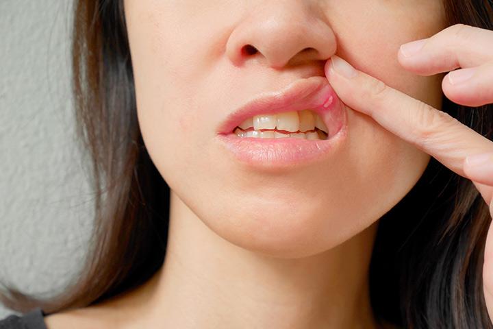 mouth-ulcers-canker-sores-in-pregnancy-causes-treatment