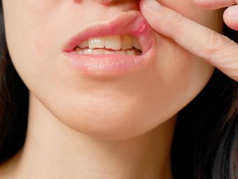 Mouth Ulcers (Canker Sores) In Pregnancy: Causes, Symptoms & Treatment
