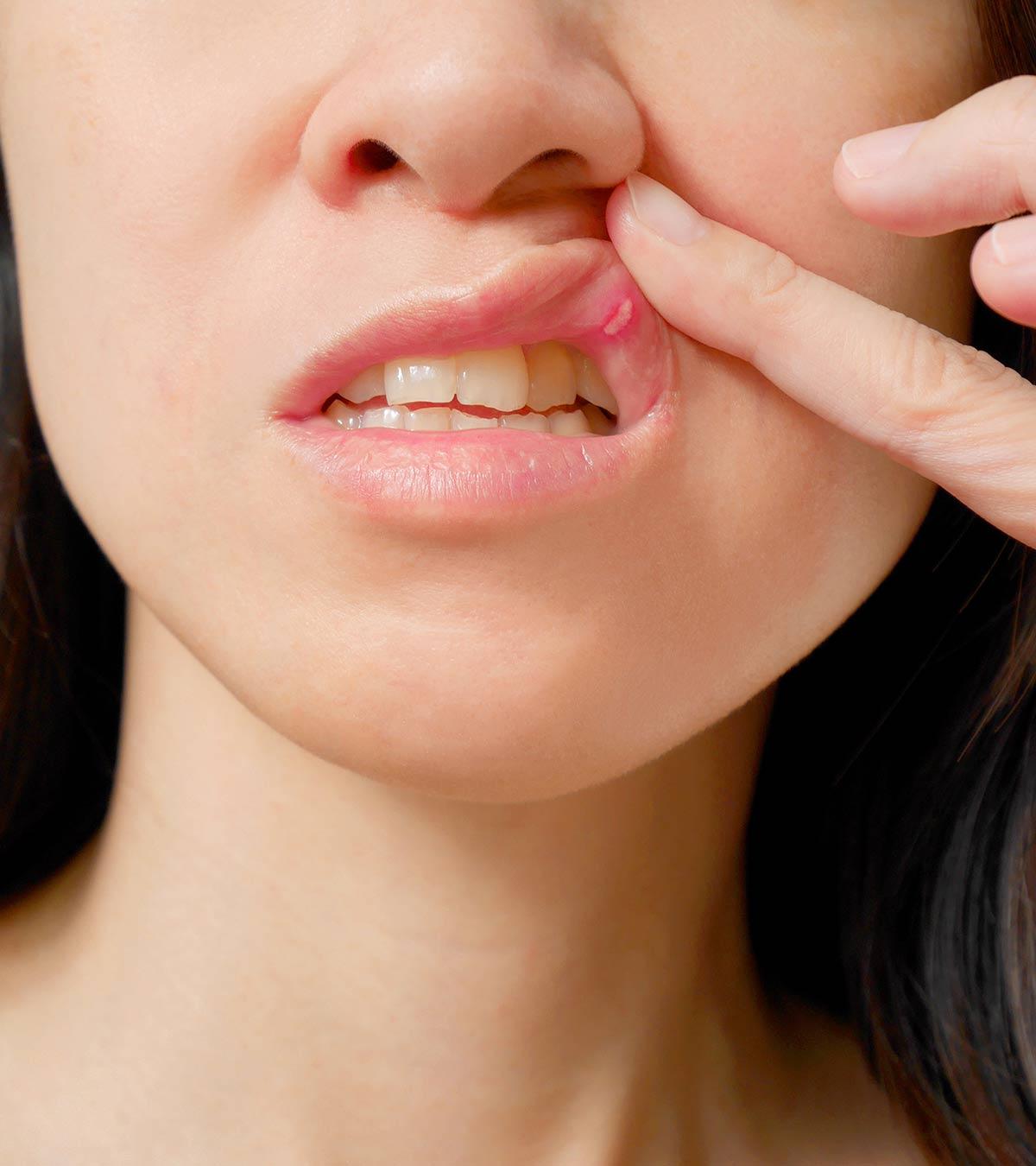 Mouth Ulcers (Canker Sores) In Pregnancy: Causes, Symptoms & Treatment