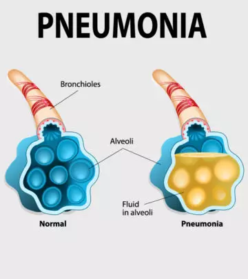 Pneumonia In Pregnancy: Signs, Complications & Treatment
