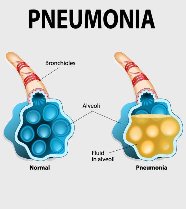 Pneumonia In Pregnancy: Signs, Complications & Treatment