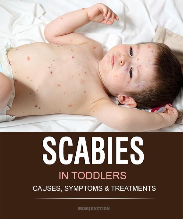 Scabies Overview Infestation Spread Treatment And Prevention Factdr