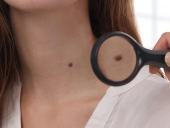 vaginal skin tags pregnancy