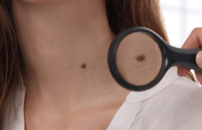 Skin Tags During Pregnancy: Causes, Treatment, And Remedies For Removal