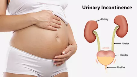 Urinary Incontinence During Pregnancy - Everything You Need To Know About It_image