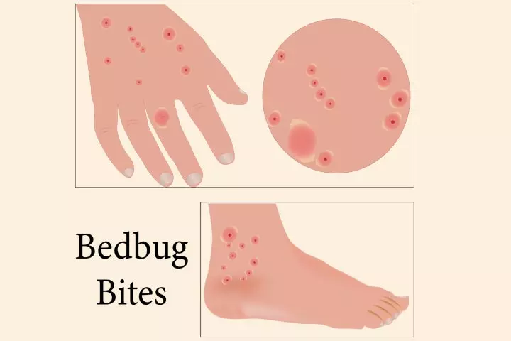 Bedbug bites on kids