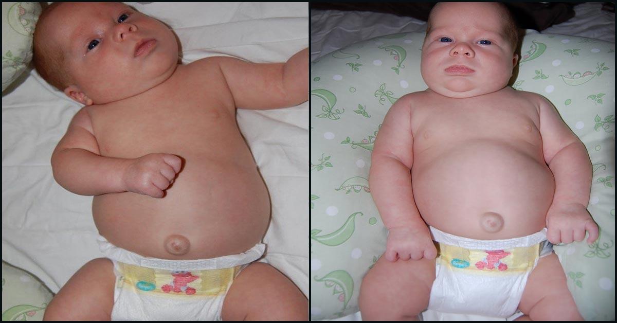 why-does-your-newborn-have-an-outie-belly-button