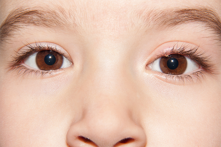 A stye may trigger periorbital cellulitis around the eyes