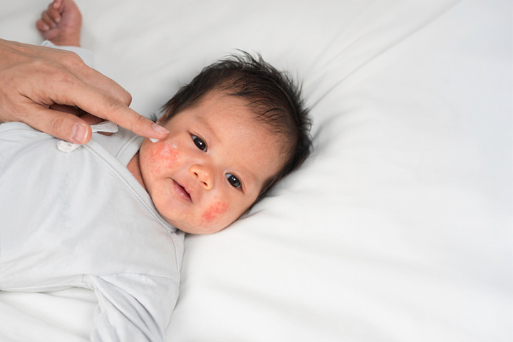 An allergy to zinc oxide may lead to eczema in babies