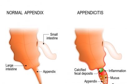 Appendicitis In Teens: Symptoms, Causes, Treatment, And Remedies