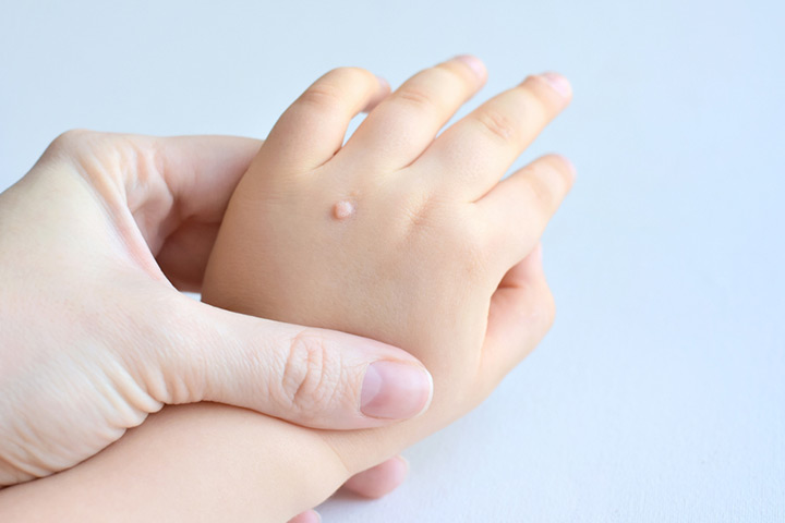 Common warts in babies
