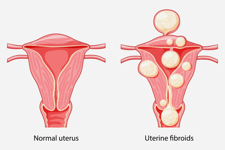 Fibroids may cause severe lower abdominal pain