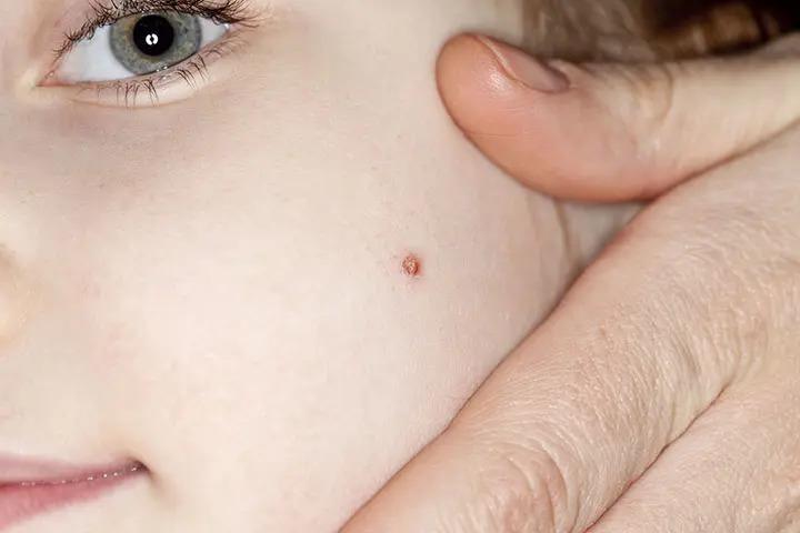 Flat warts in babies